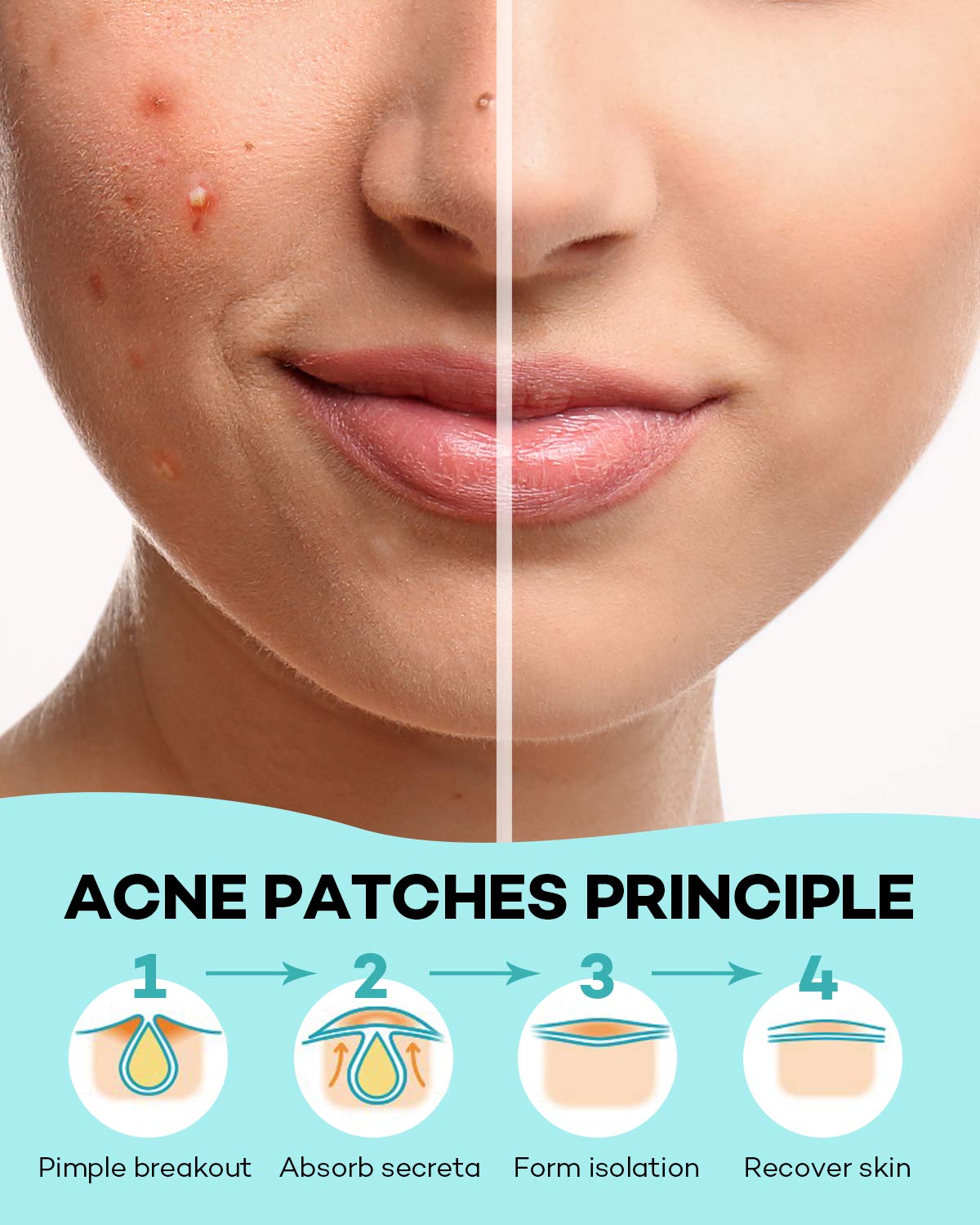 Skin Tag Acne Remover Patch