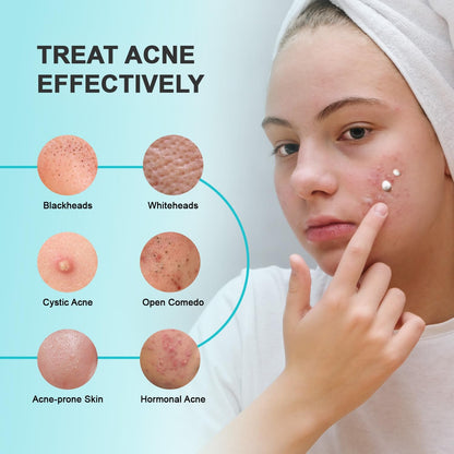 Natural Acne Treatment Gel Cream with 10% Azelaic Acid