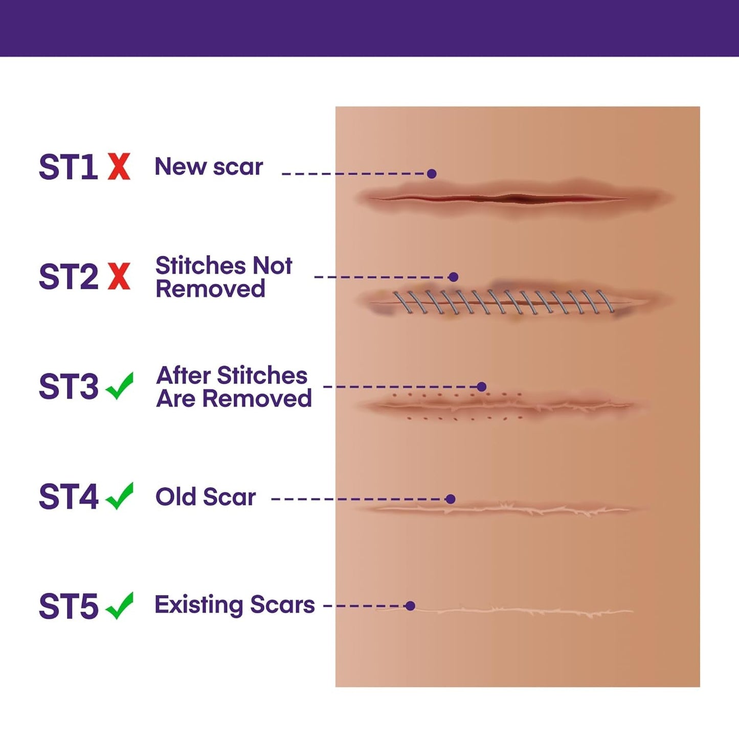 Silicone Scar Cream with SPF 30 for Sensitive Skin