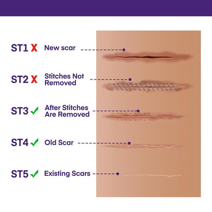 Silicone Scar Cream with SPF 30 for Sensitive Skin
