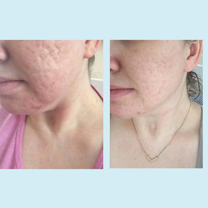 Intensive Glycolic Acid 50% Face Peel 30ml - Deep Exfoliate Renew