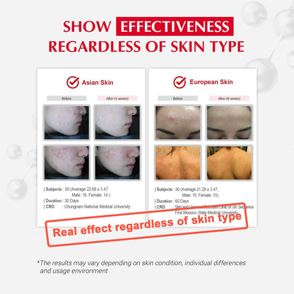 Effective Peptide Acne Control Lotion