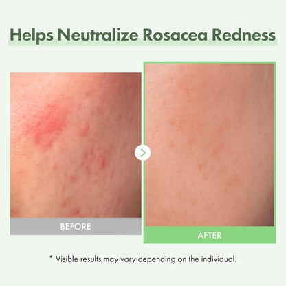 Natural Anti Redness Face Serum 33ml