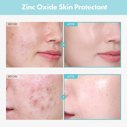 Soothing Acne Relief Face Cream with Zinc 50g