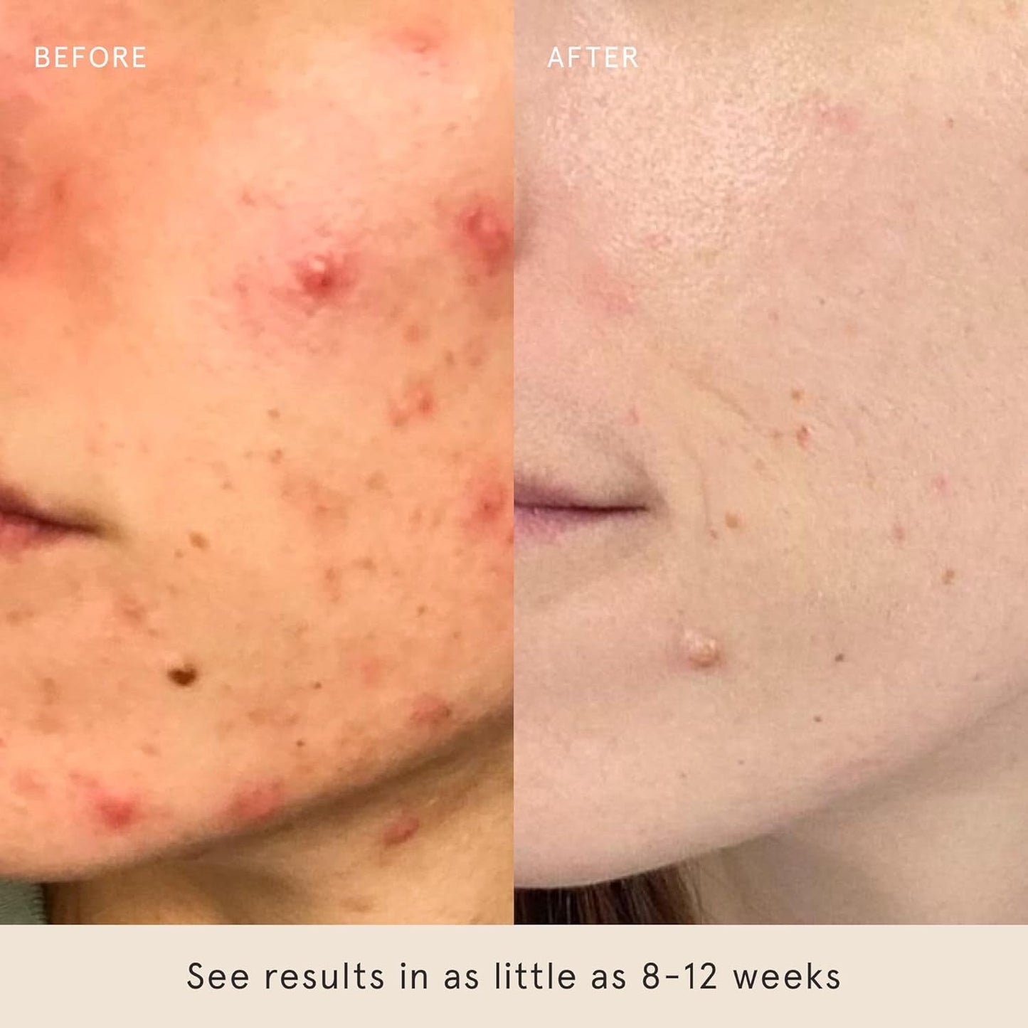 Gentle Exfoliating Pads - Clear Skin & Natural Glow