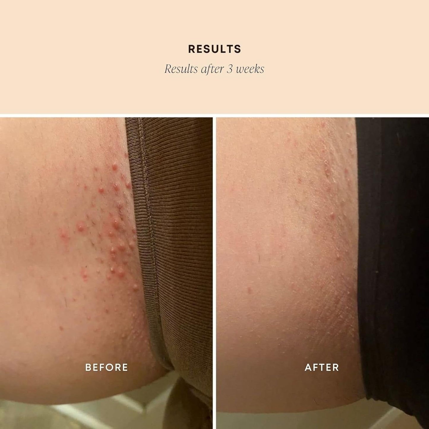 Gentle Exfoliating Scrub for Ingrown Hairs