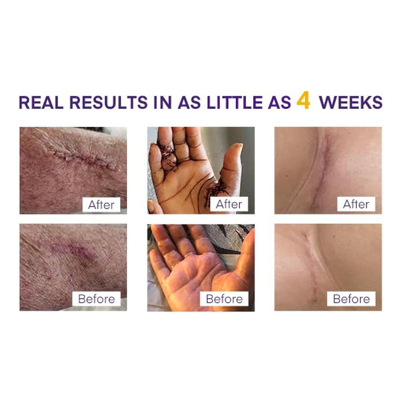 Silicone Scar Cream with SPF 30 for Sensitive Skin