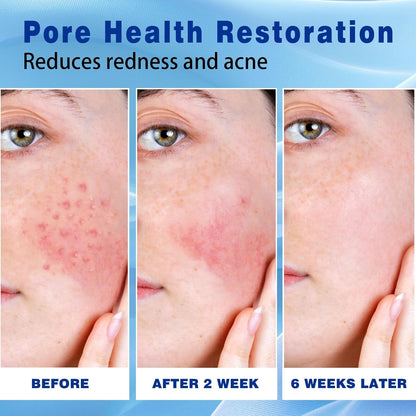 Natural Acne Treatment Cream with 10% Azelaic Acid