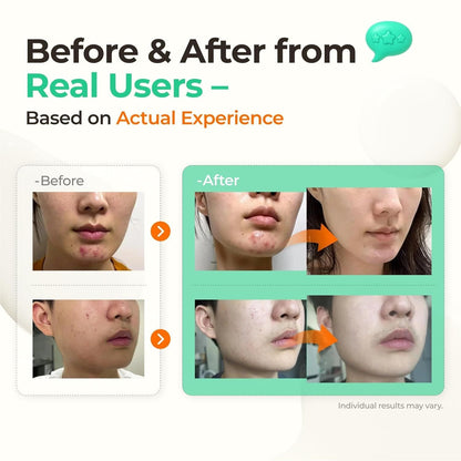 Gentle Sulfur Serum for Acne & Sensitive Skin