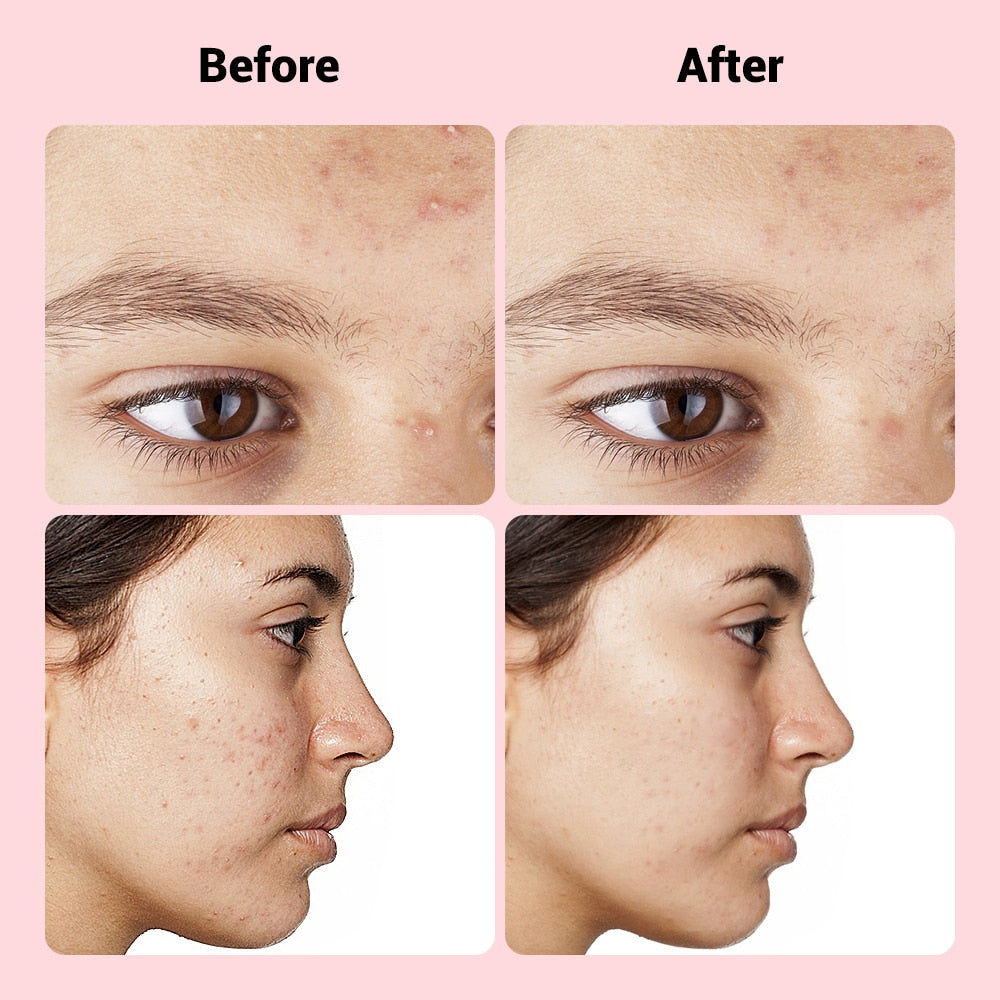 Acne Spot Treatment Patches 9 Pack - Quick Fix Skin Repair