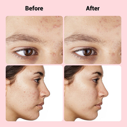 Acne Spot Treatment Patches 9 Pack - Quick Fix Skin Repair