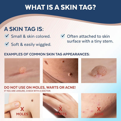 Easy At-Home Skin Tag Removal Device