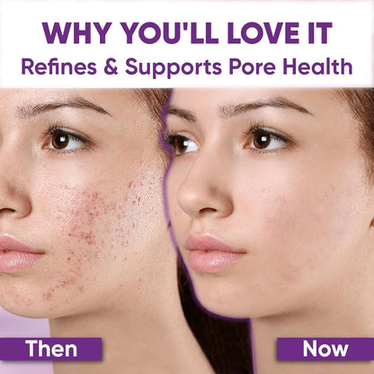 Natural Acne & Redness Relief Face Serum 30ml