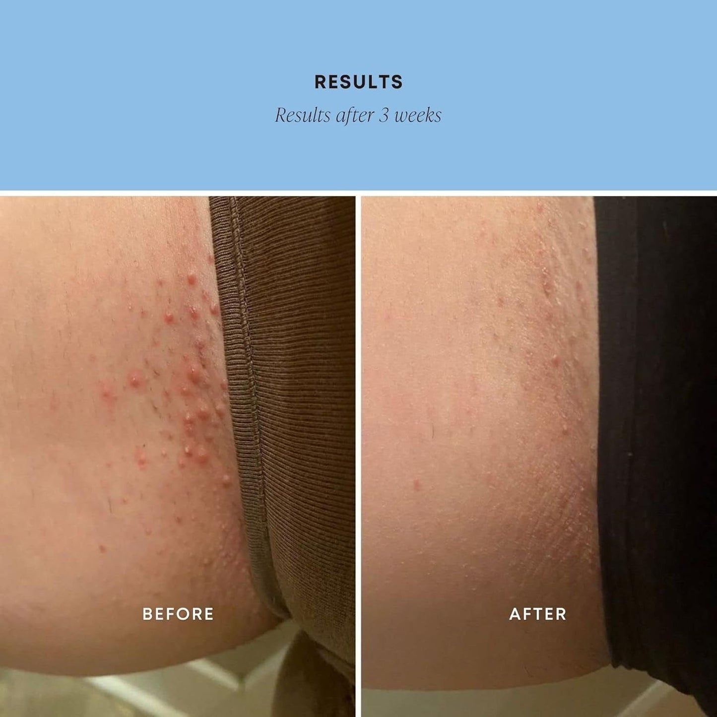 Gentle Ingrown Hair Removal Scrub for Soft Skin