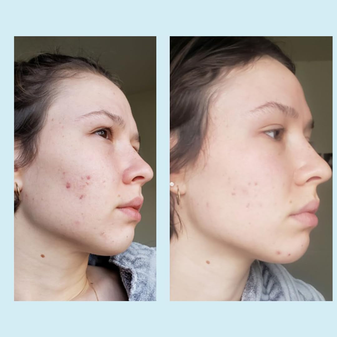 Intensive Glycolic Acid 50% Face Peel 30ml - Deep Exfoliate Renew