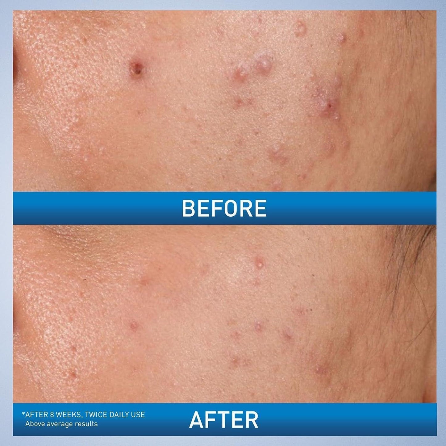 Salicylic Acid Acne Gel for Clear Skin - 40ml