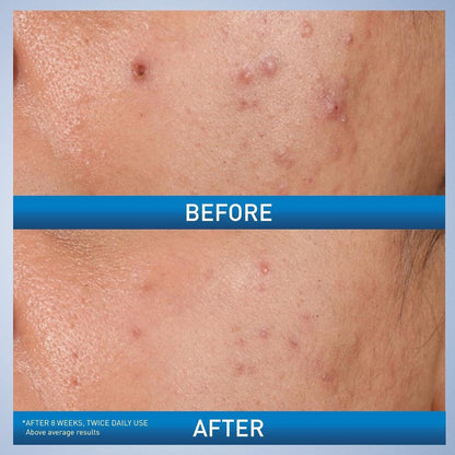 Salicylic Acid Acne Gel for Clear Skin - 40ml