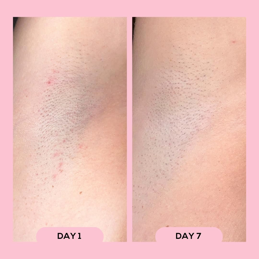 Soothing Post Shave Roll On For Ingrown Hair Relief