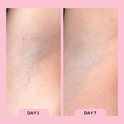 Soothing Post Shave Roll On For Ingrown Hair Relief