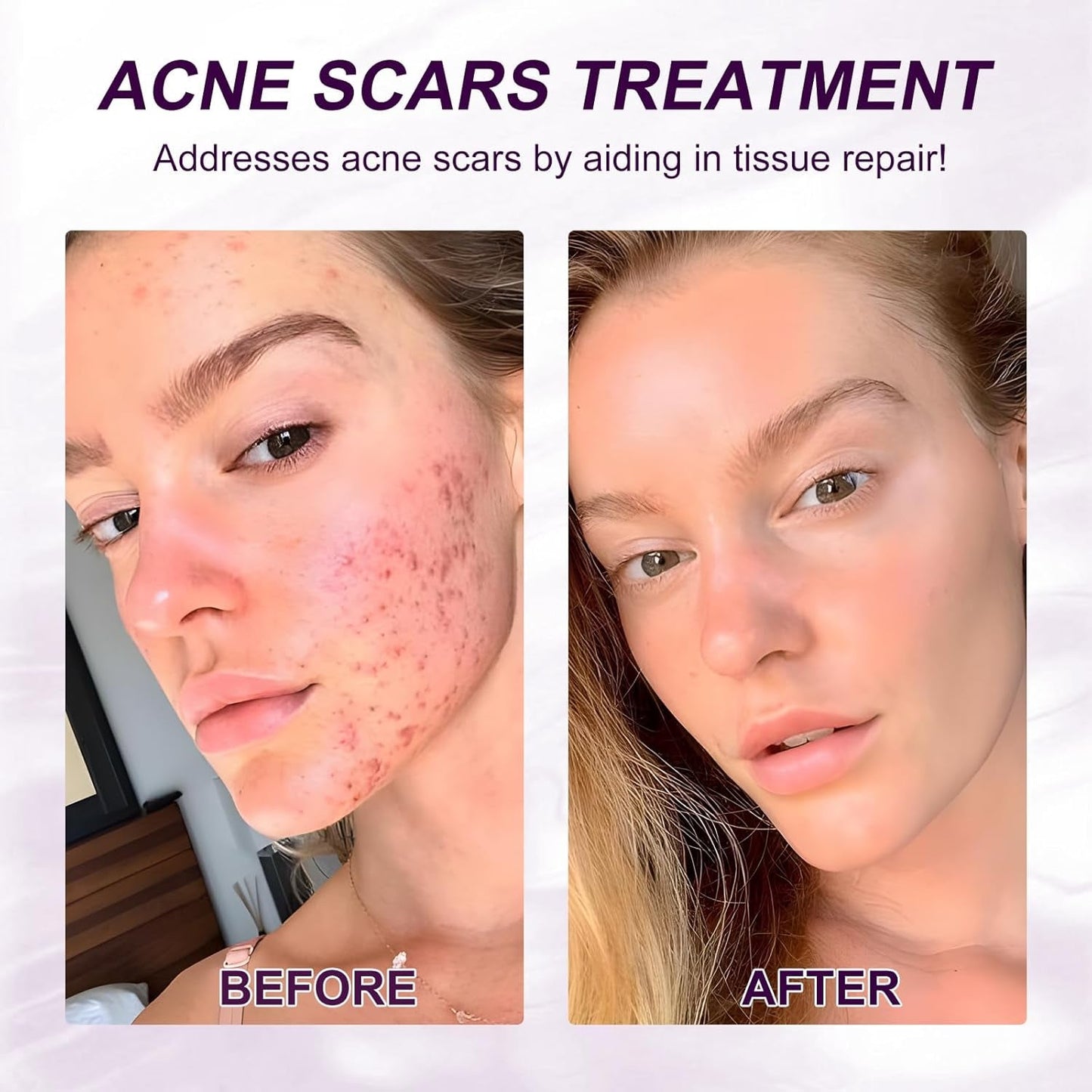 Gentle Azelaic Acid Serum for Soothing Red Skin