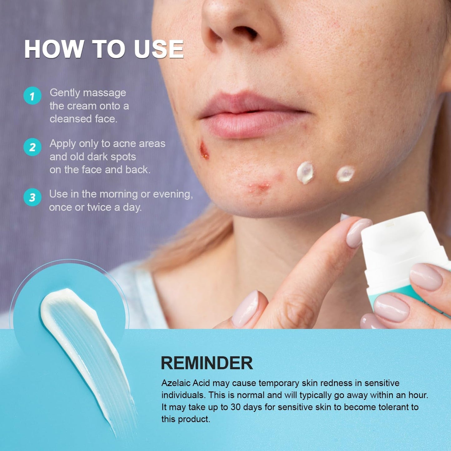 Natural Acne Treatment Gel Cream with 10% Azelaic Acid