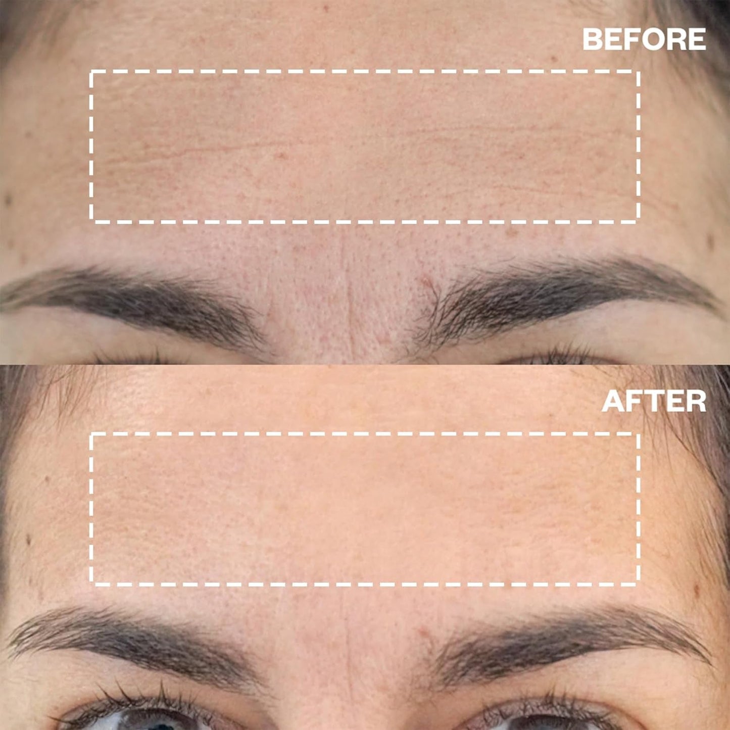 Anti Aging Forehead Smoothing Patches