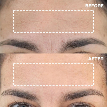 Anti Aging Forehead Smoothing Patches