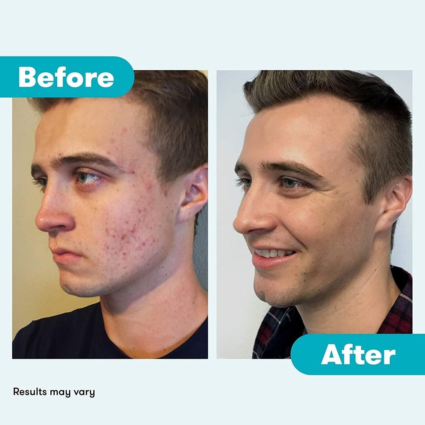 Effective Daily Acne Face Wash with Benzoyl Peroxide