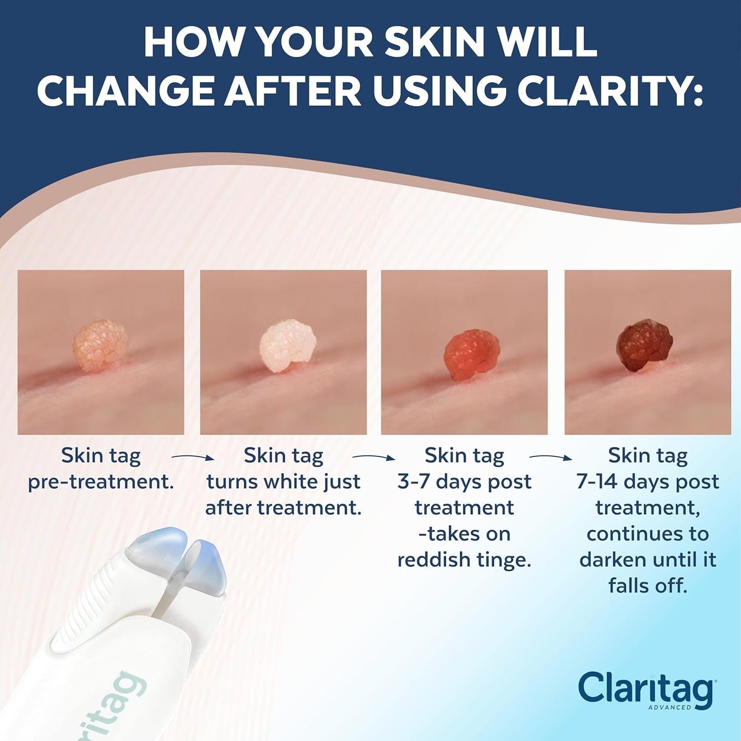 Easy At-Home Skin Tag Removal Device