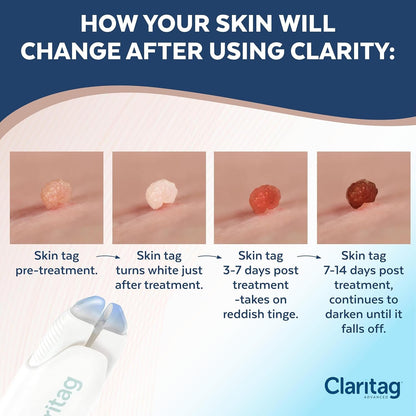 Easy At-Home Skin Tag Removal Device