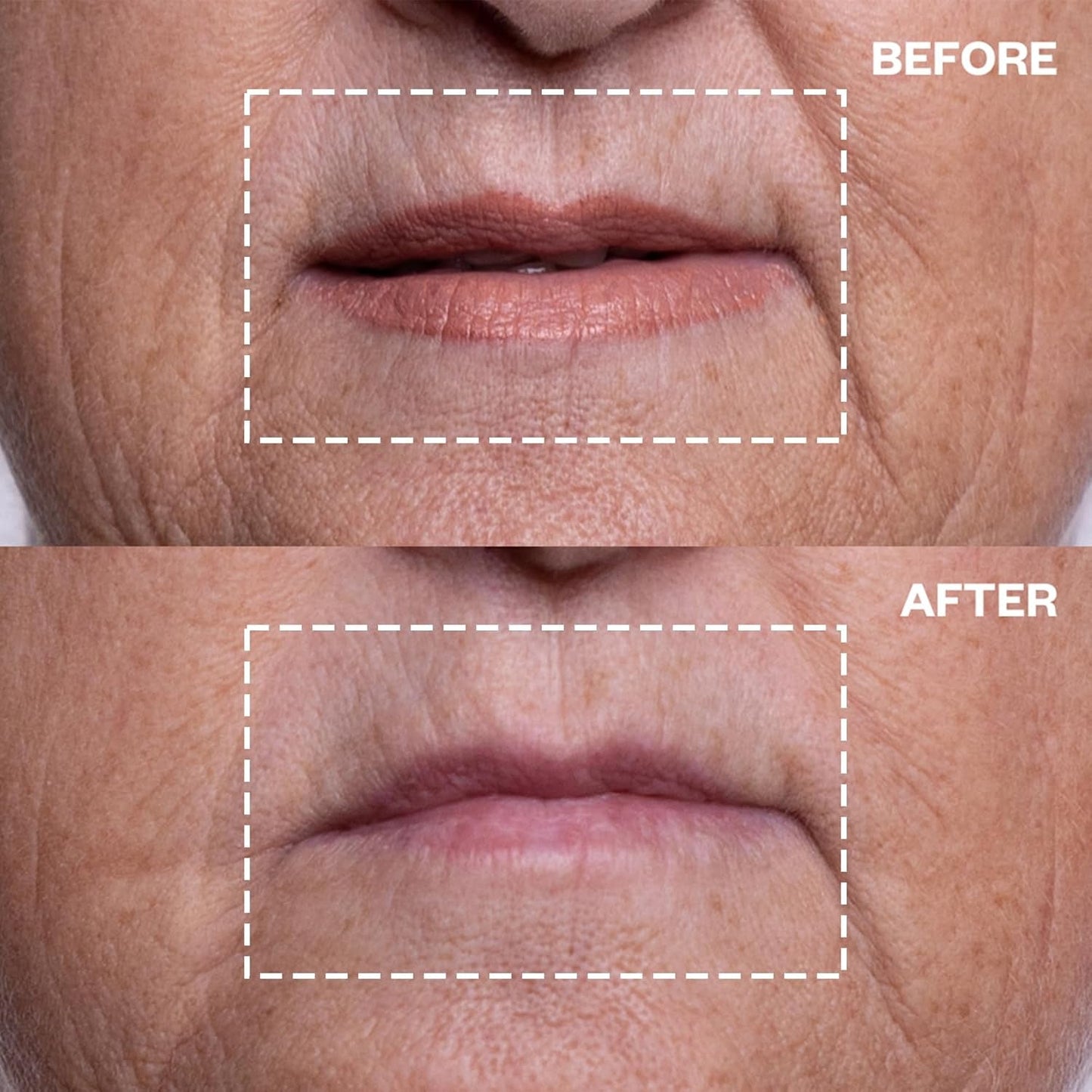 Anti Aging Lip Wrinkle Patches - Reusable Silicone Smoothers