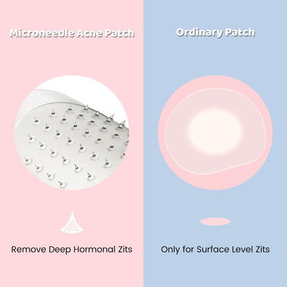Acne Spot Treatment Patches 9 Pack - Quick Fix Skin Repair