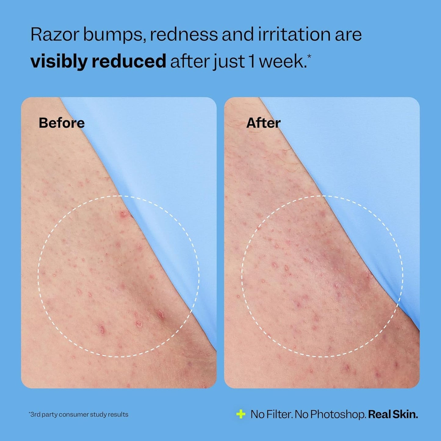 Gentle Ingrown Hair Remedy - 50ml | Reduce Bumps & Redness