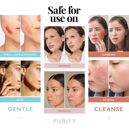 Gentle Skin Acne Spray 237ml - Soothing Hydration