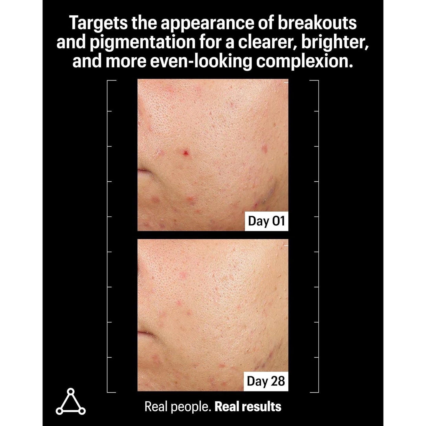 Powerful Azelaic Acid Skin Clarifying Serum 30ml