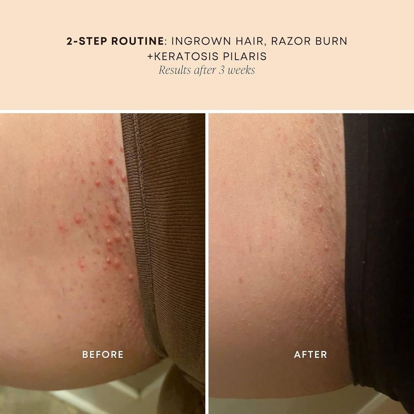 Natural Ingrown Hair Relief Oil
