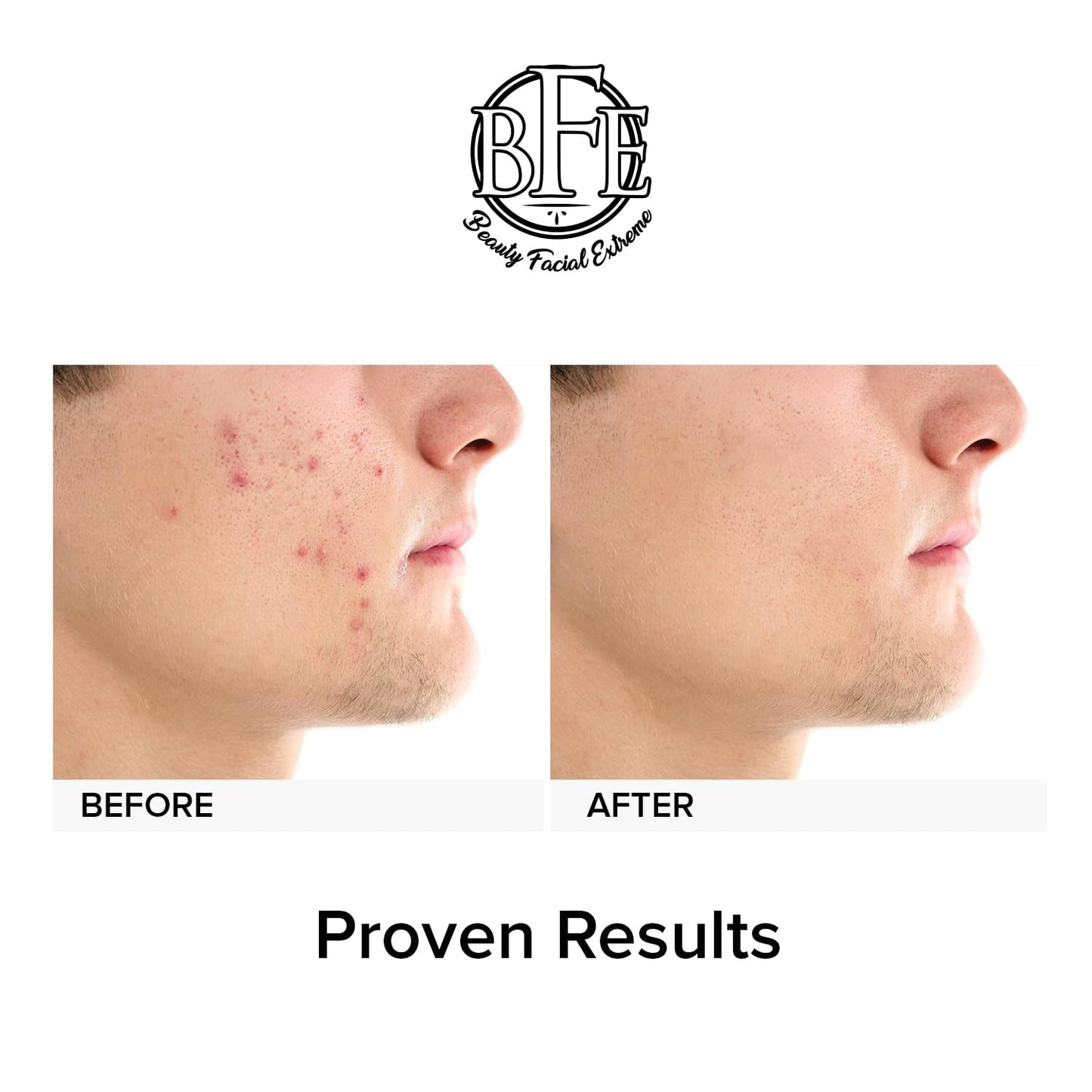 Effective Acne Treatment Pads with Salicylic Acid