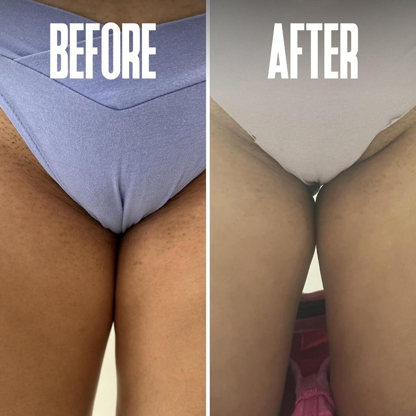 Soothing Ingrown Hair Removal Pads