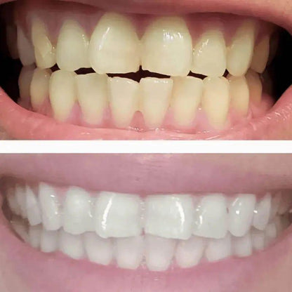 Professional At-Home Teeth Whitening Kit with LED Light
