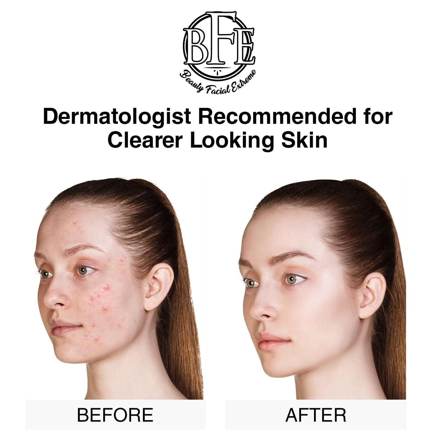 Effective Acne Treatment Pads with Salicylic Acid