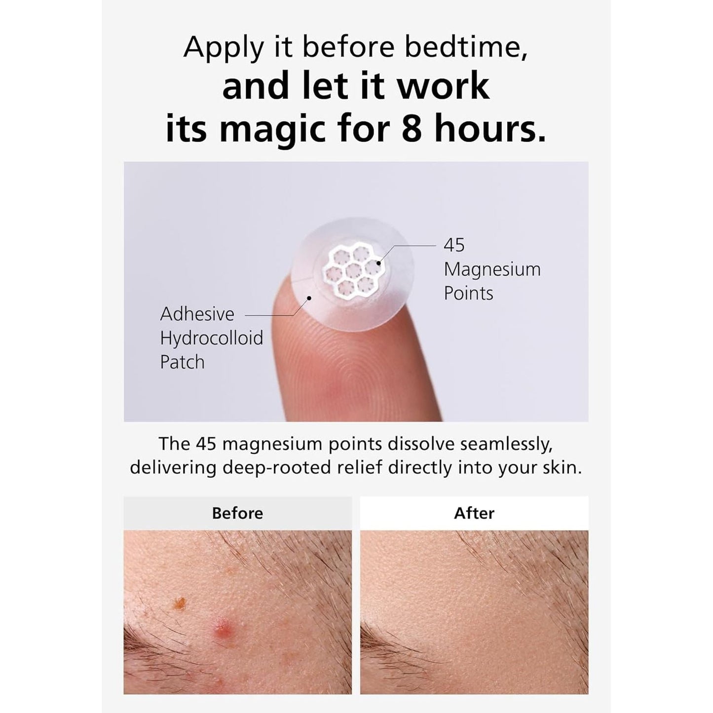 Soothing Magnesium Acne Patches - 30 Count Korean Spot Treatment