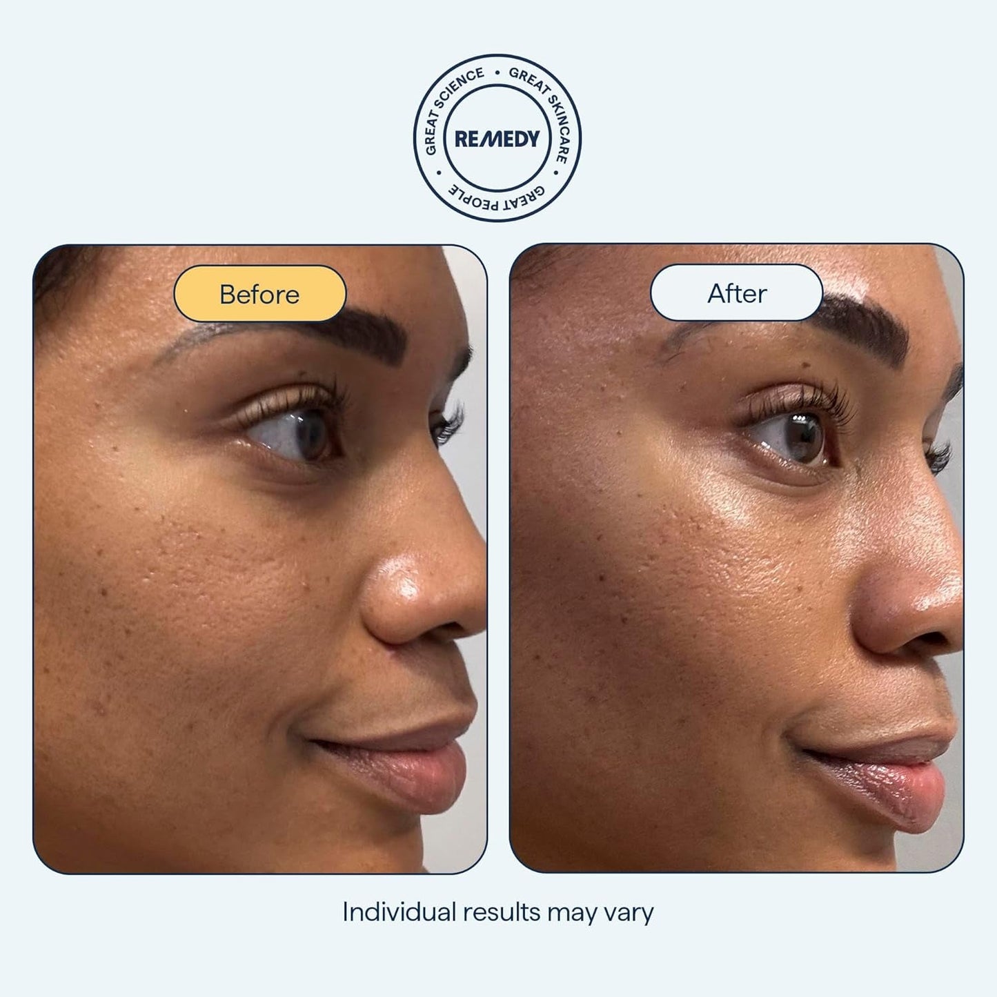 Intensive Hydrating Cream Moisturizer for Dry Skin