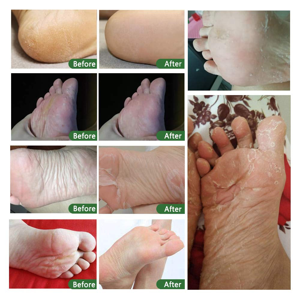 Gentle Exfoliating Foot Mask 5 Pack - Softens Rough Feet