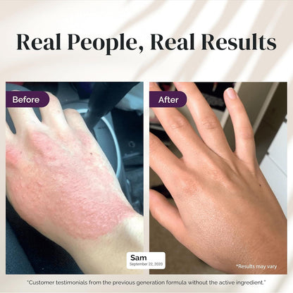 Natural Eczema Cream - Soothing Dry Skin Moisturizer