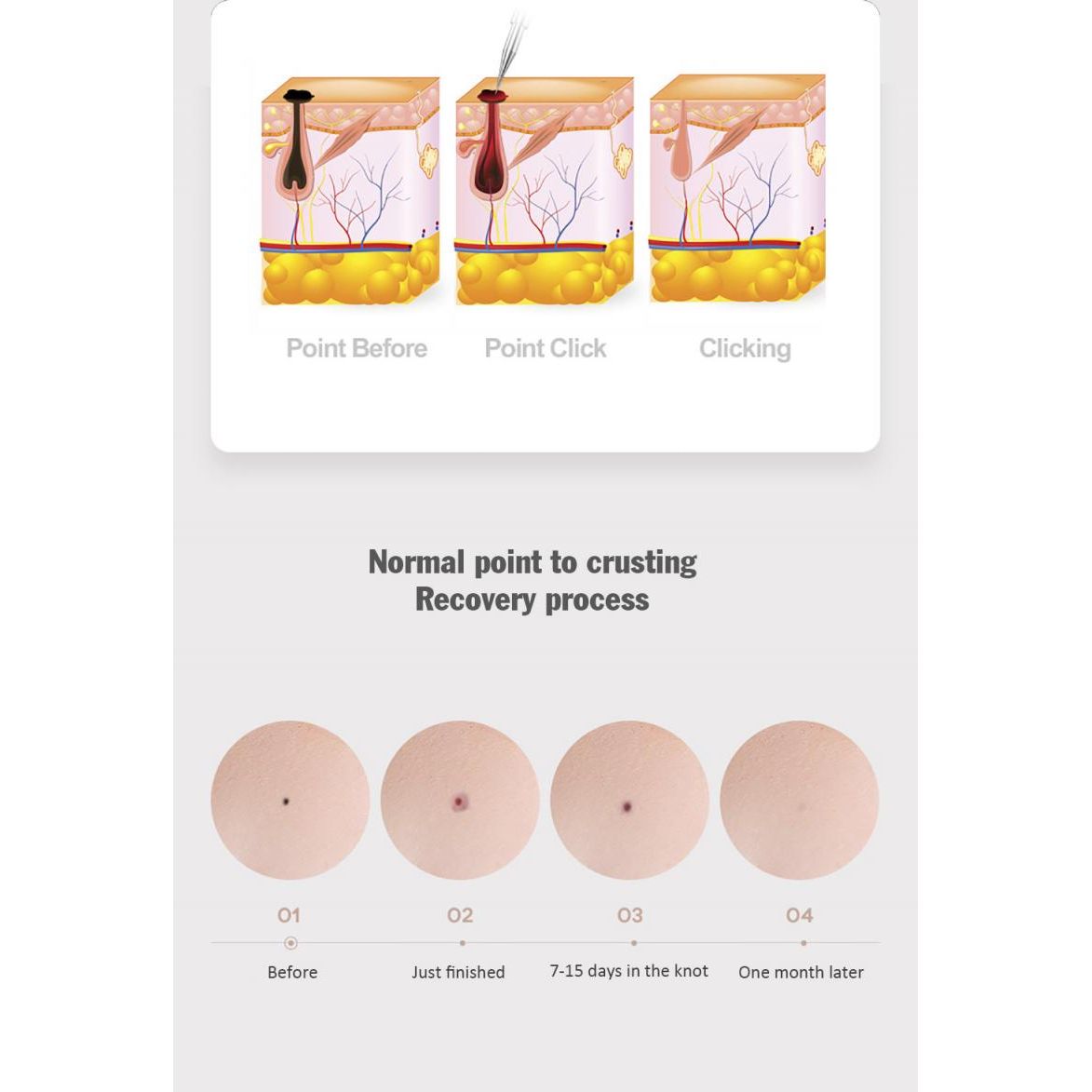 Professional Skin Tag Removal Laser Pen