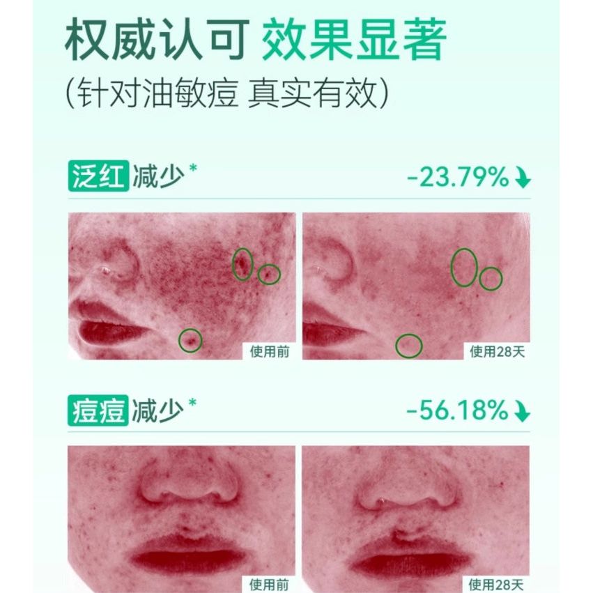 Soothing Acne Serum for Sensitive Skin 15ml