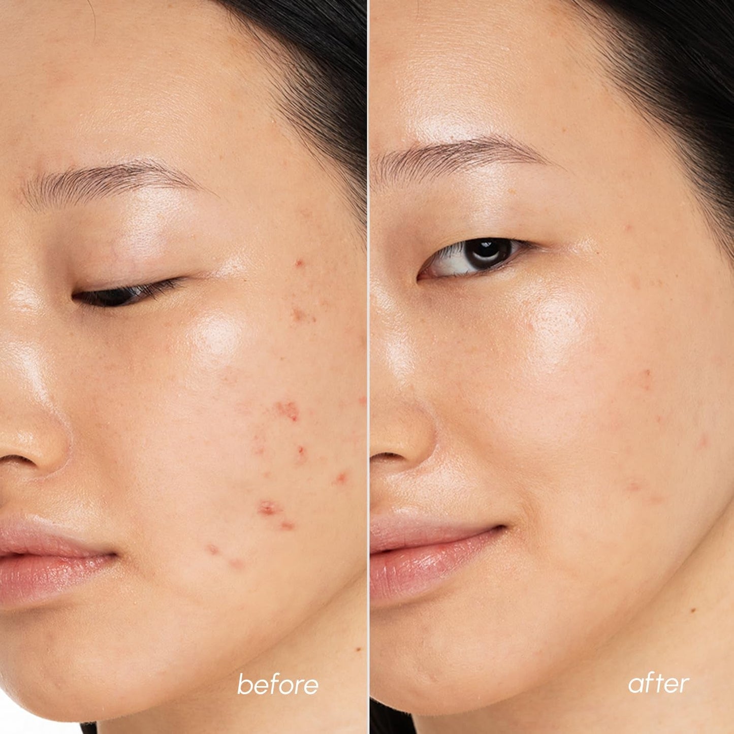 Gentle Exfoliating Toner Pads for Acne Prone Skin