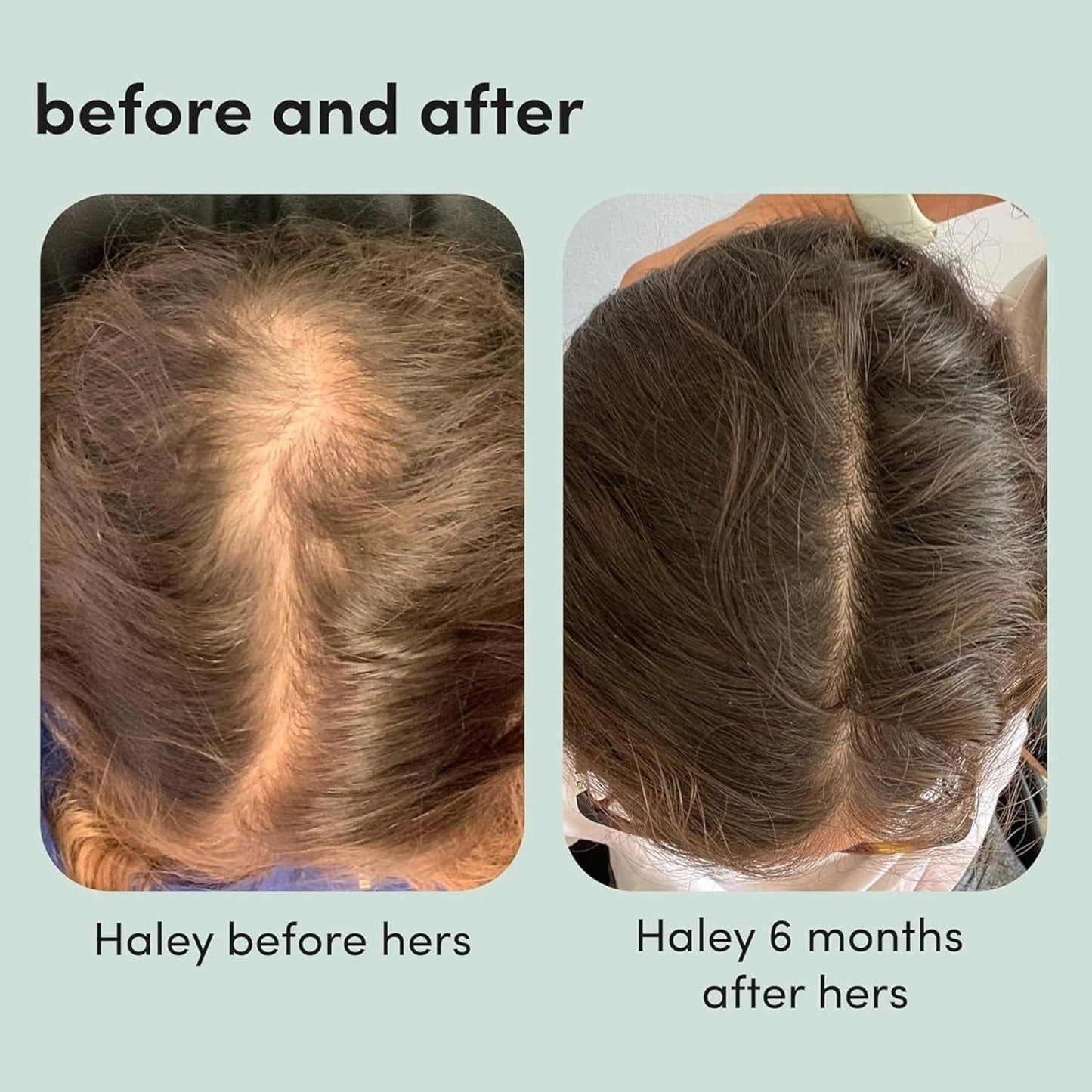Women's Hair Growth Treatment 2% Minoxidil Solution