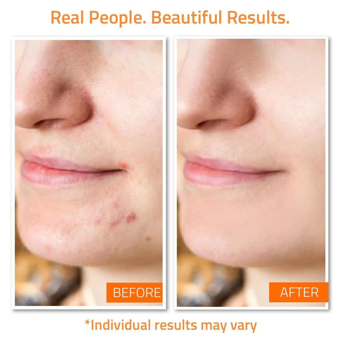 Natural Anti Acne Skin Care Kit with Vitamin C
