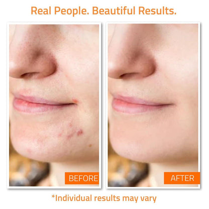 Natural Anti Acne Skin Care Kit with Vitamin C